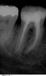 Endodontie5