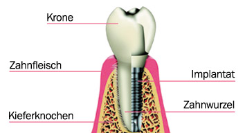 Implantat