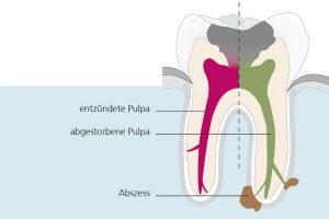 zahn-erkrankung