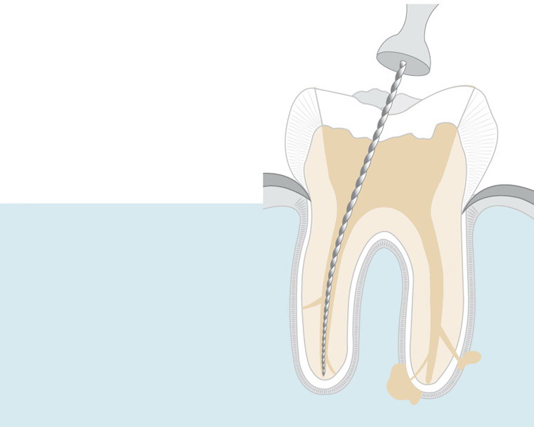 wurzelkanalbehandlung-1