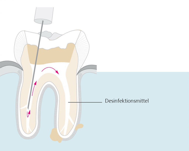 wurzelkanalbehandlung-2
