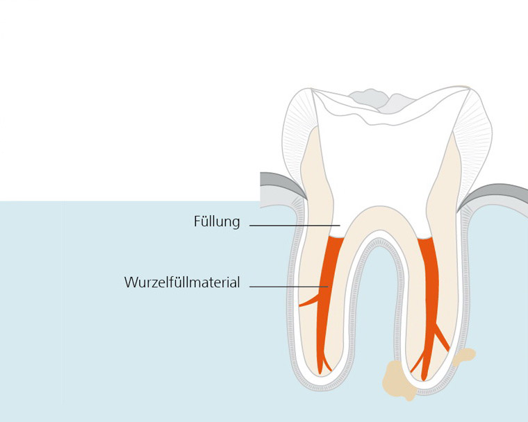 wurzelkanalbehandlung-3