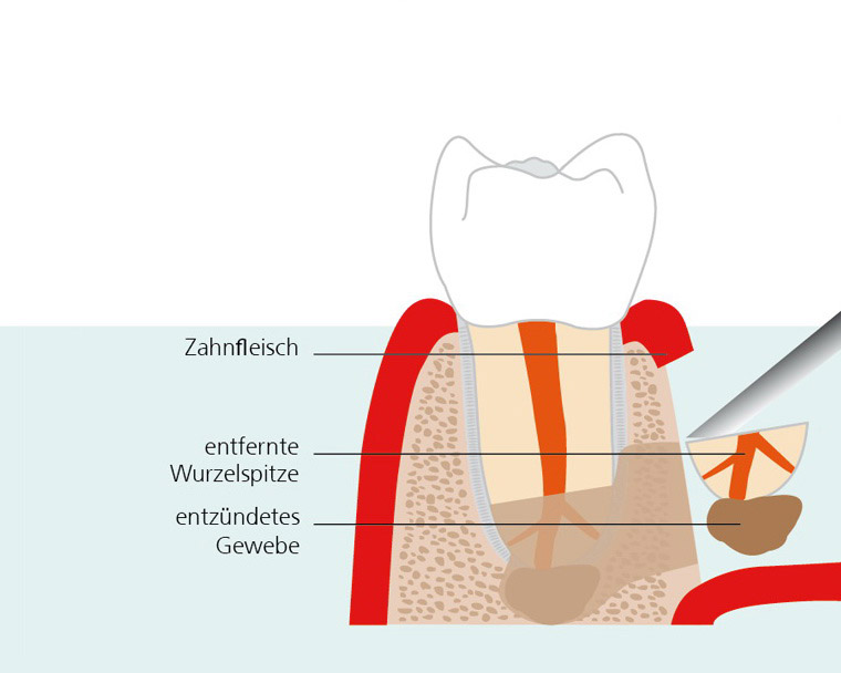 endodontische-chirurgie-2