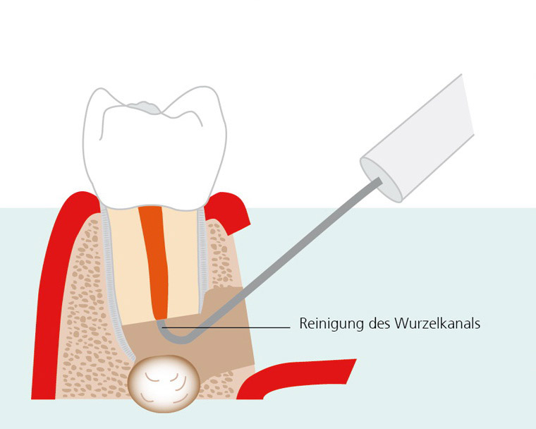 endodontische-chirurgie-3