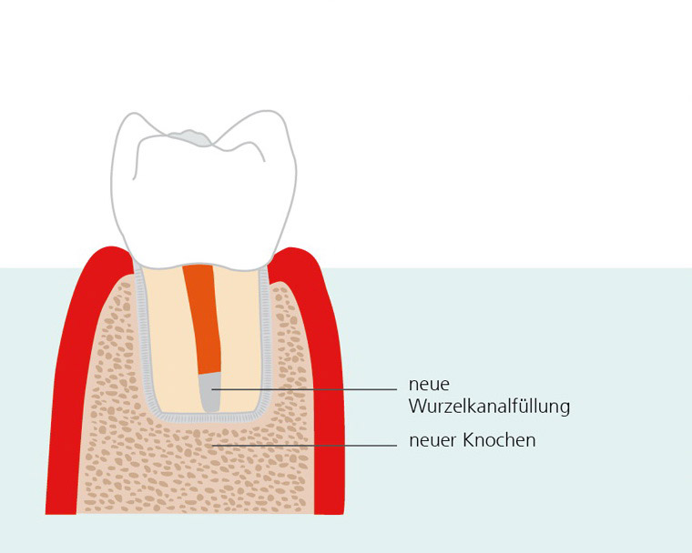 endodontische-chirurgie-3